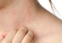 Sintomas do Zika Vírus podem ser confundidos com alergia